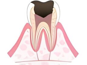 中等度の虫歯