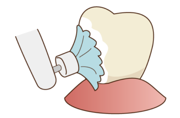 歯のクリーニングイラスト